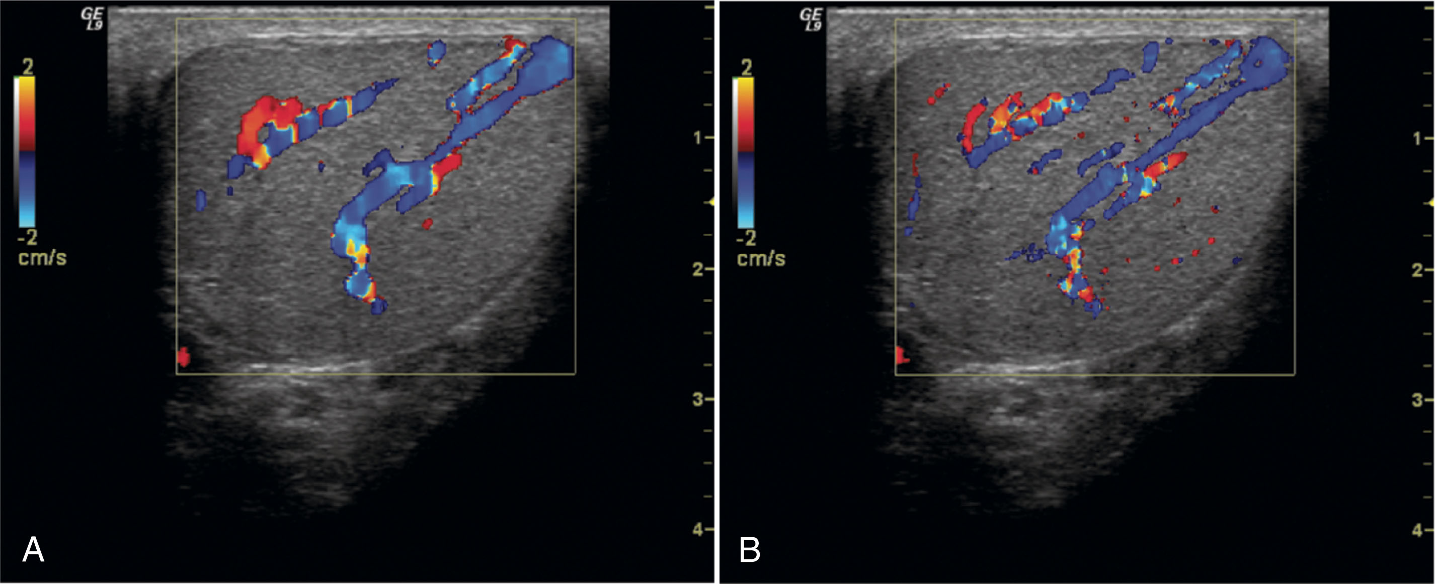 Fig. 23.13, (A) This image was obtained at a low line density setting. The vessels appear wider than expected (poor lateral resolution). (B) When the line density is increased, the vessel size is more accurately displayed. Frame rate is slower because more scan lines are present within the same-sized color box.