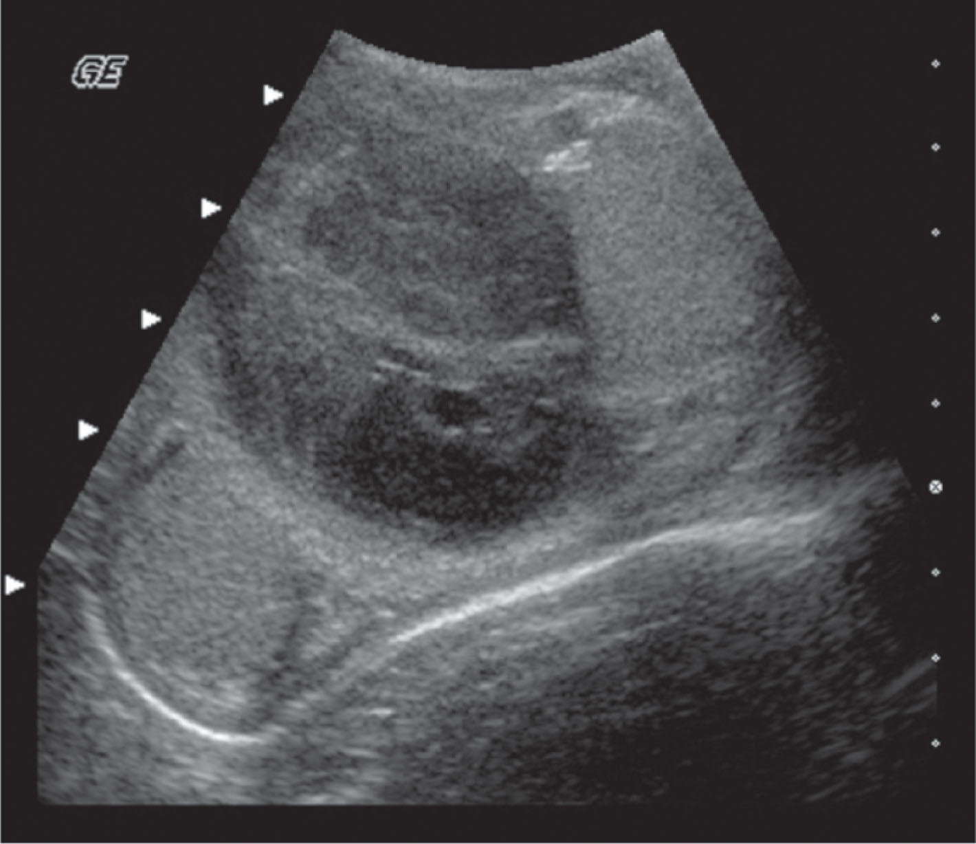 Fig. 23.14, Complex hematoma in a patient with hemophilia following scrotal trauma. Transverse ultrasound scan of both testes shows a large heterogeneous mass adjacent to the left testis. Color Doppler (not shown) demonstrated the mass to be avascular.