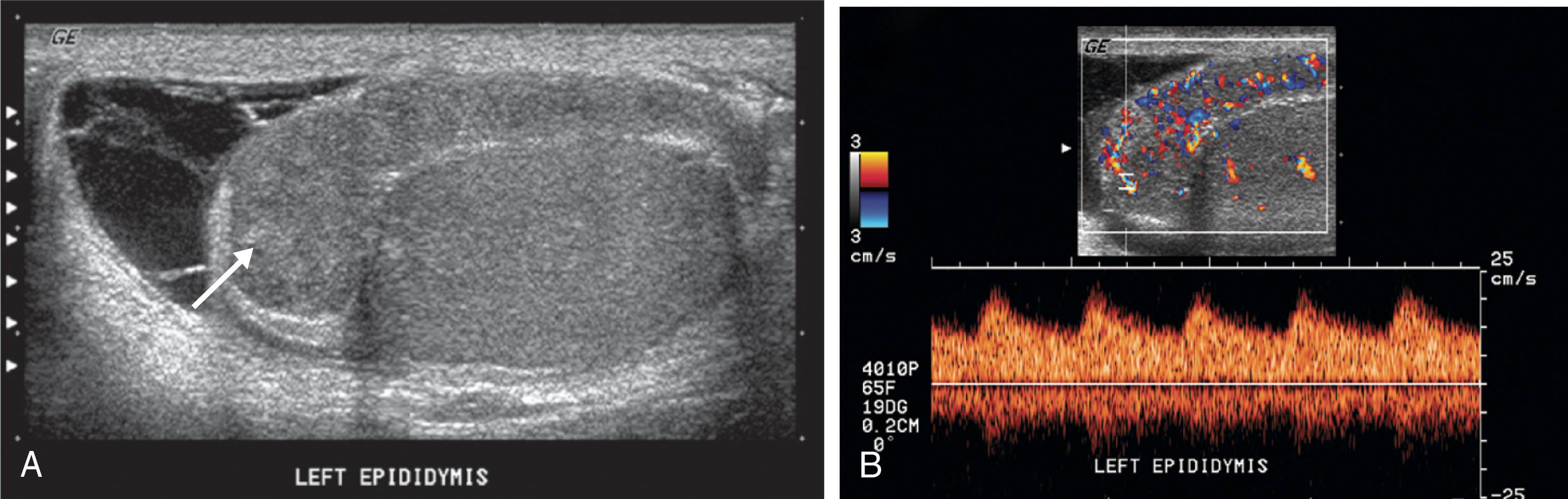 Fig. 23.15, (A) Sagittal ultrasound image in a patient with severe epididymitis shows an enlarged epididymis with a heterogeneous echotexture. Focal hyperechoic areas (arrow) within the epididymis may represent hemorrhage. A complex hydrocele with numerous septations is shown near the epididymal head. (B) Color Doppler shows hyperemic flow within the epididymis. A Doppler waveform obtained from the epididymal head shows increased diastolic flow associated with inflammation.