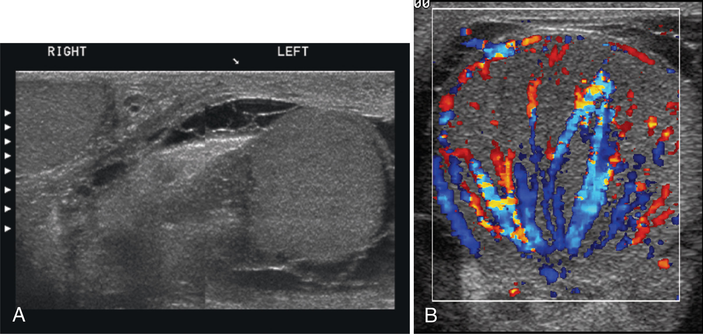 Fig. 23.16, (A) Orchitis in a patient presenting with severe scrotal pain and swelling. Transverse stitched ultrasound scan shows an enlarged left testis and a normal right testis. A complex hydrocele surrounds the left testis. Marked skin thickening is present on the left side compared with the normal right side. (B) Color Doppler shows hyperemic flow.