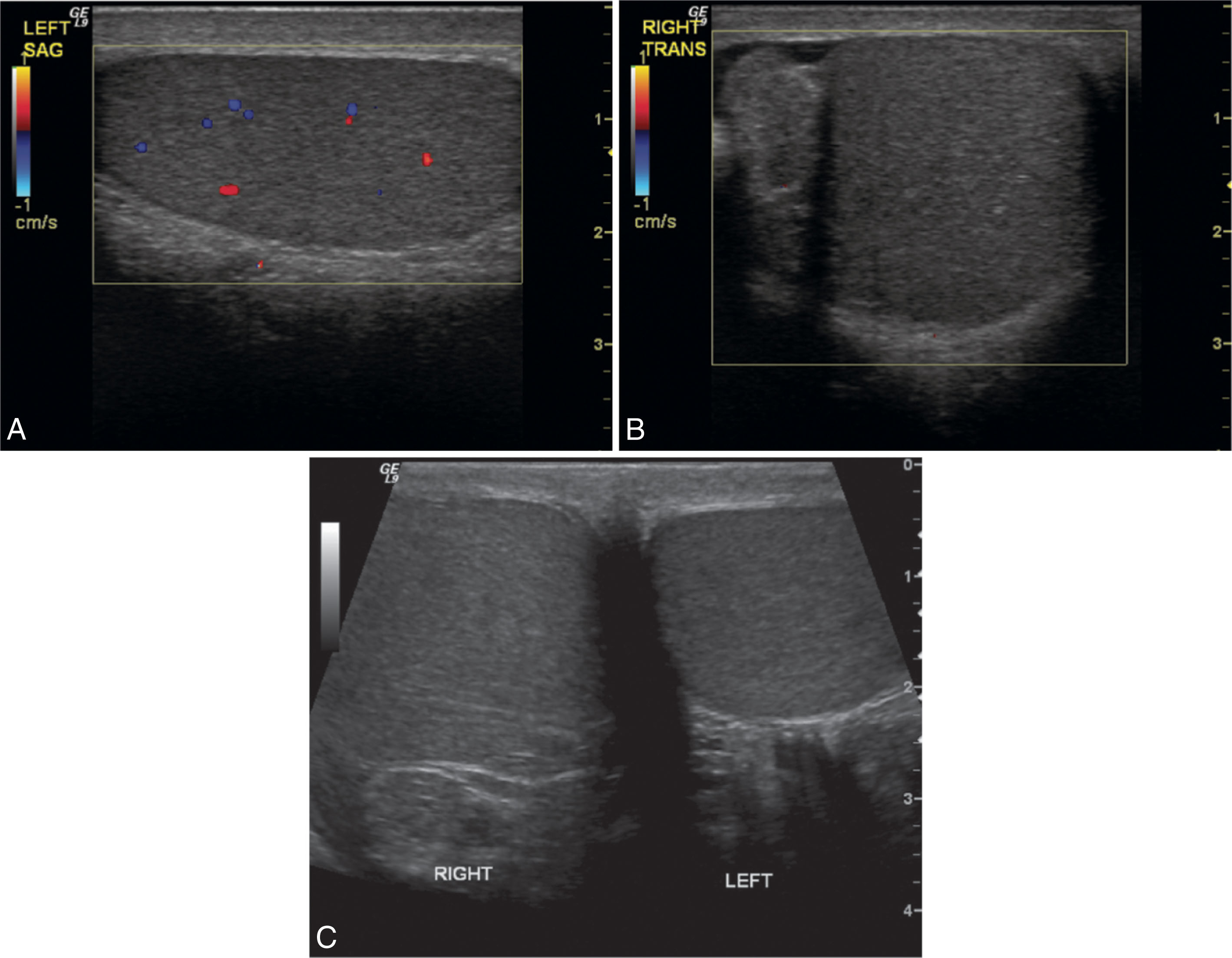 Fig. 23.18, Testicular torsion in an adolescent patient with sudden onset of right testicular pain, accompanied by nausea and vomiting. (A) Color Doppler shows normal flow within the parenchyma of the left testis. (B) The right testis and epididymis are avascular with color Doppler imaging, with the same settings used to show flow on the asymptomatic side. (C) Transverse ultrasound image showing both testes in right testicular torsion. The right testis is swollen and hyperechoic compared with the normal left testis.