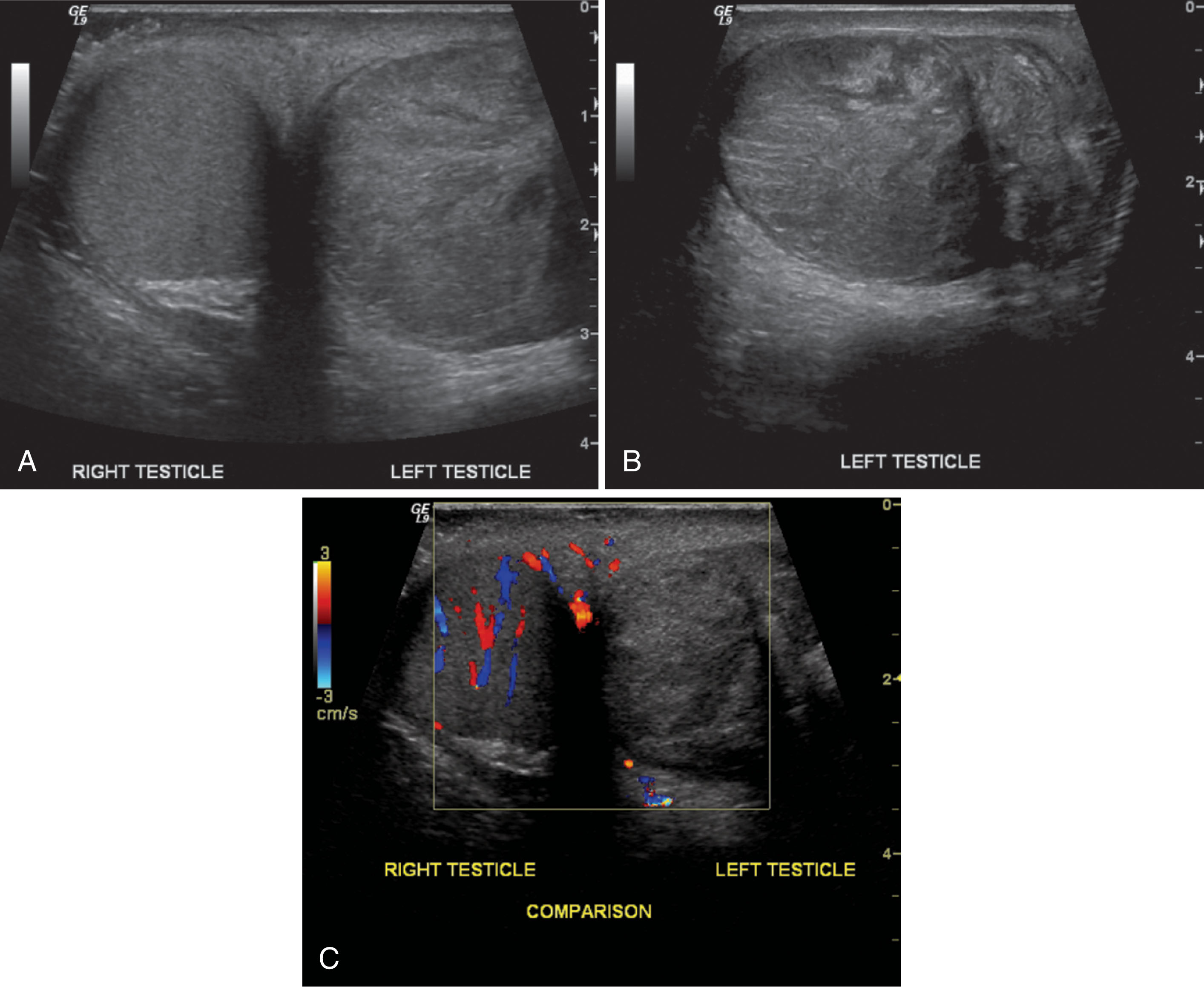 Fig. 23.19, Left spermatic cord torsion in adolescent with a history of scrotal pain of duration greater than 24 hours. (A) Transverse ultrasound image showing both testes. The left testis is enlarged and heterogeneous. (B) Sagittal ultrasound image of the left testis. The infarcted testis has a mixed echo pattern caused by the hemorrhage, necrosis, and vascular congestion associated with spermatic cord torsion exceeding 24 hours. (C) Transverse color Doppler image showing normal perfusion to the right testis with absence of detectable signal on the left side. Paratesticular blood flow is increased around the abnormal testis.