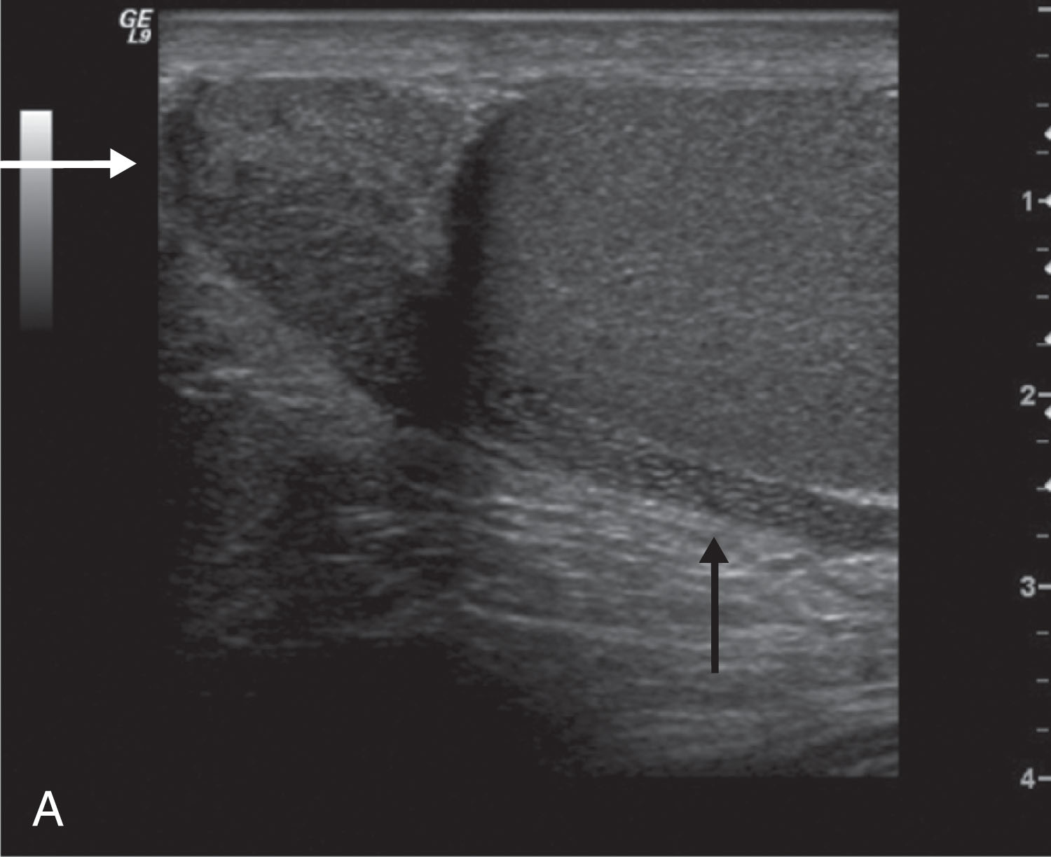 Fig. 23.2, (A) Sagittal ultrasound scan of a normal epididymis and testis. The head of the epididymis is seen superior to the upper pole of the testis (white arrow) . The body of the epididymis is seen posterior to the testis (black arrow) . Note the coarse echotexture of the epididymis compared with the fine texture of the testis. (B) Three-dimensional (3D) view rendered in the coronal plane demonstrates the relationship of the normal epididymal head to the superior pole of the testis. (C) 3D view shows orthogonal planes of enlarged epididymis in patients with epididymitis. An axis point (small white dot) is placed on the epididymal head to demonstrate the same point in three orthogonal views. The 3D data set allows manipulation of the volume in an infinite number of imaging planes. This allows the sonographer to adjust the display so that the entire length of the epididymis can be demonstrated.