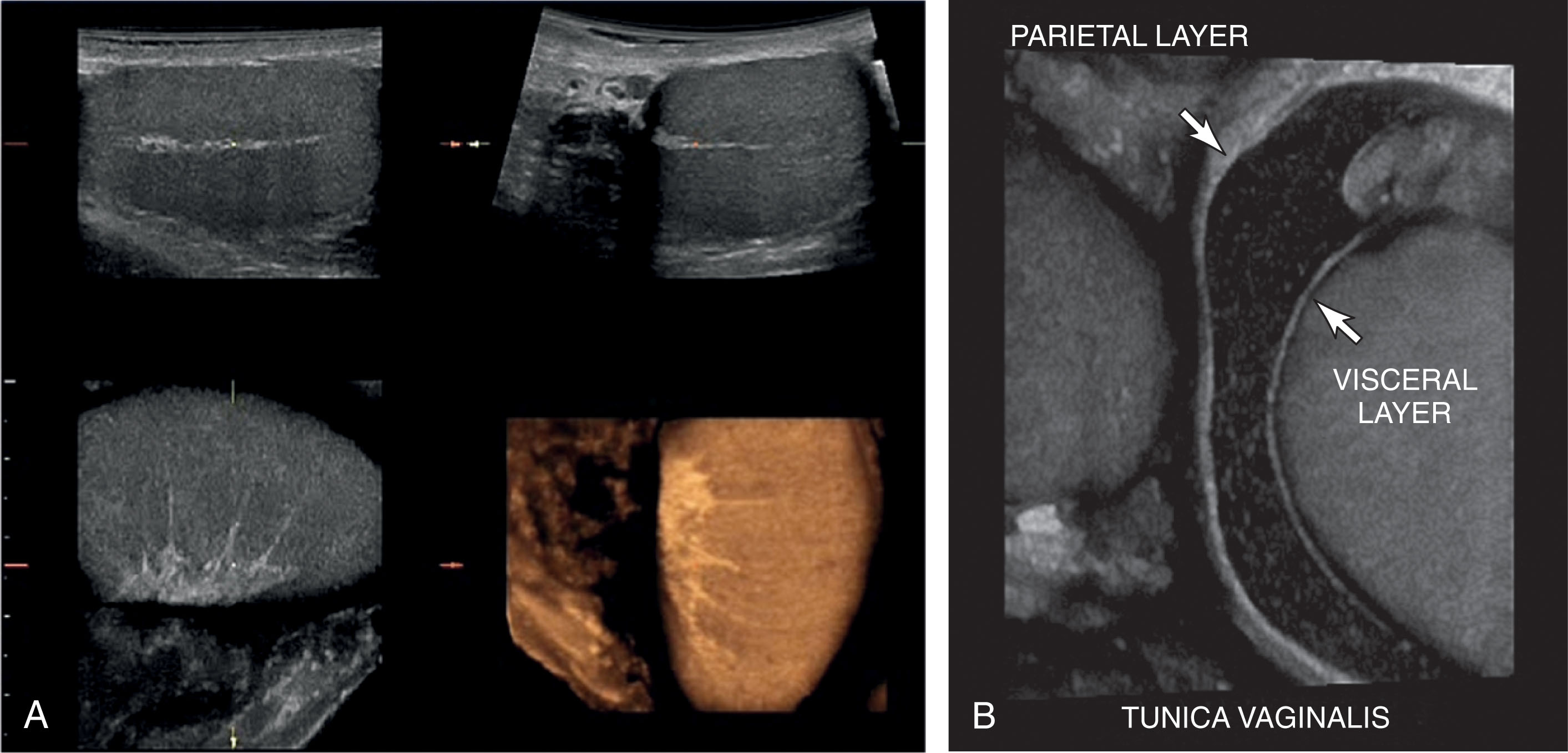 Fig. 23.4, (A) Three-dimensional (3D) view showing the mediastinum testis in orthogonal planes with the septa. This image was obtained with a 3D transducer sweeping in the sagittal plane (upper left) . The transverse image is derived from the 3D volume and is displayed upper right. 3D view allows visualization of the coronal plane (lower left) . The coronal plane is rarely imaged with traditional 2D imaging. A rendered view of the testis is seen in the lower right. (B) 3D coronal view demonstrating the layers of the tunica vaginalis (arrows) . This is well demonstrated because of the presence of a hydrocele. Hydroceles form between the parietal and visceral layers of the tunica vaginalis.