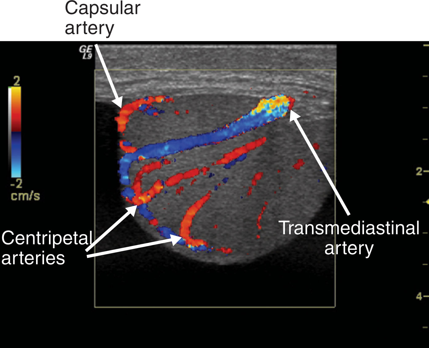 Fig. 23.6, Color Doppler image of the testis depicting the capsular artery giving rise to centripetal arteries. A transmediastinal artery is seen coursing from the mediastinum to the testicular surface. It then branches across the top of the testis as capsular arteries. The flow direction in the transmediastinal artery (blue) is opposite to that in the centripetal arteries (red) . The centripetal arteries rise from the capsular arteries with a flow direction through the testis toward the mediastinum, whereas the blood flow in the transmediastinal artery courses from the mediastinum to the testicular capsule.