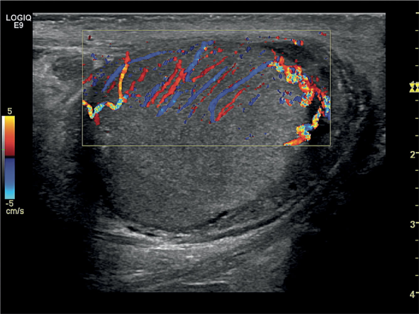 Fig. 23.7, Color Doppler image of the testis depicting the recurrent rami.