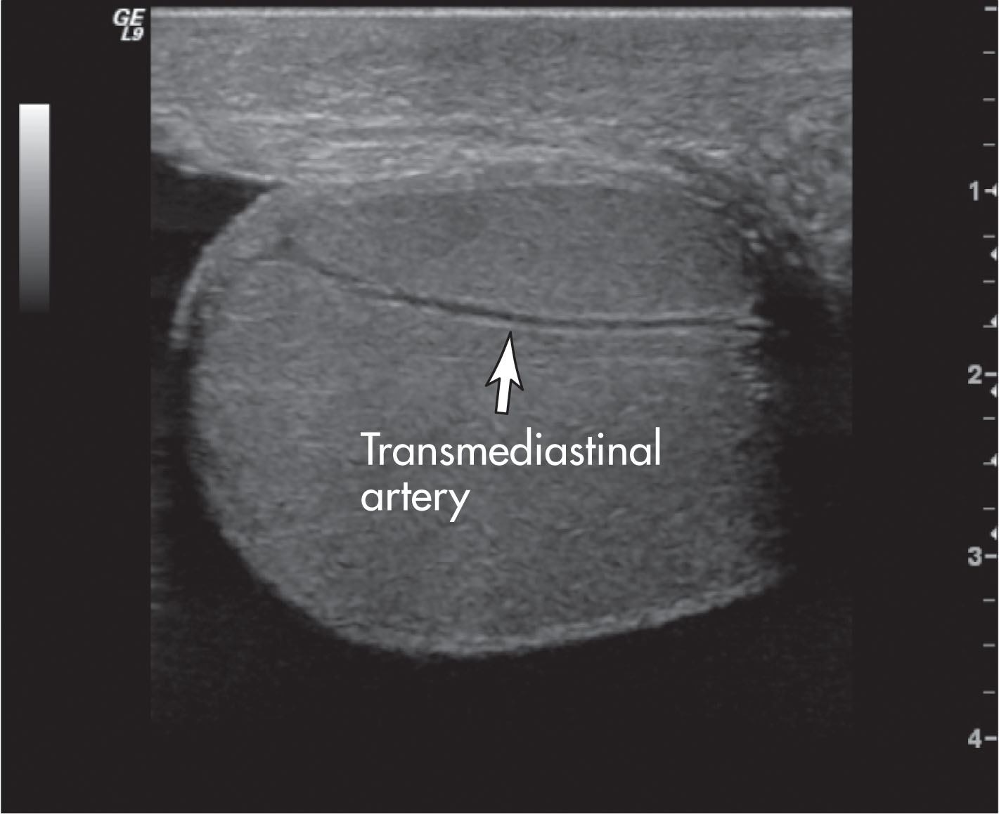 Fig. 23.8, Transverse ultrasound image shows a normal transmediastinal artery coursing from the mediastinum to the testicular capsule. It appears as an anechoic or hypoechoic tube. Transmediastinal arteries are seen in approximately 50% of testes.