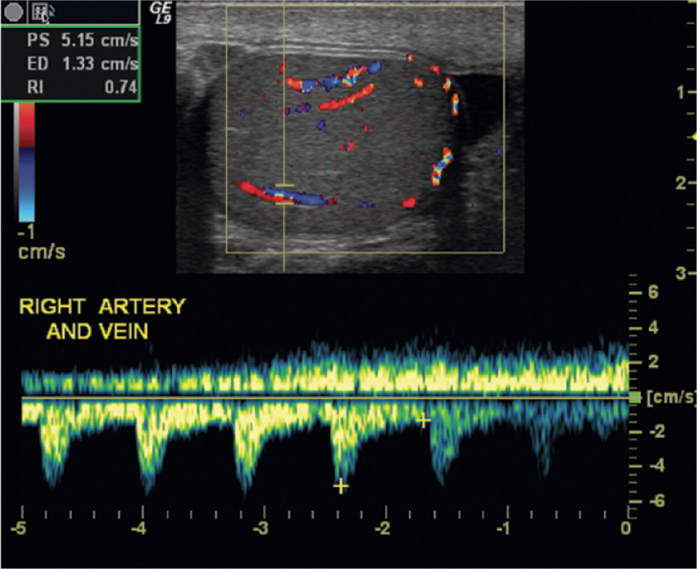 Fig. 23.9, Spectral Doppler image showing the normal low-resistance waveform pattern of the intratesticular arteries. A low-resistance waveform demonstrates forward flow during both systole and diastole. In this image, the Doppler sample volume includes both a transmediastinal artery and its accompanying vein. The venous and arterial flow signals are on opposite sides of the Doppler baseline, as their flow is in opposite directions.