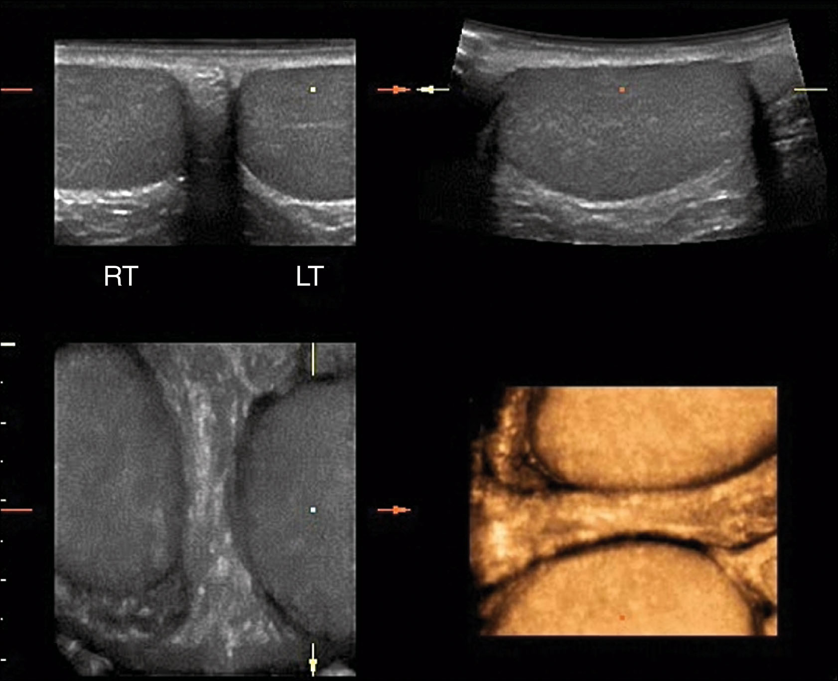 Fig. 23.10, Transverse three-dimensional sweep obtained at the midline in a normal patient demonstrating both testes. The size, echogenicity, and texture are similar between sides. It is advisable to obtain an image like this in all cases to allow comparison between the testes.