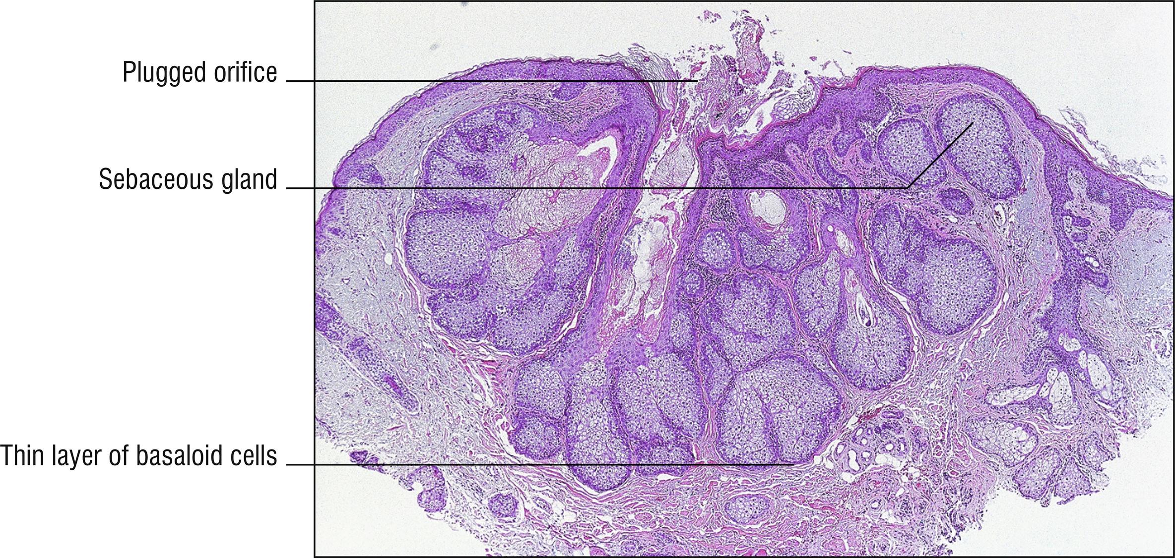 Fig. 21.1, Sebaceous hyperplasia.