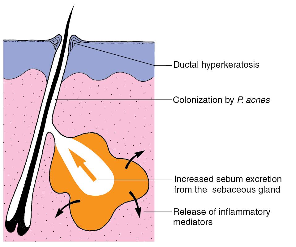 Fig. 36.1, The aetiopathogenesis of acne.