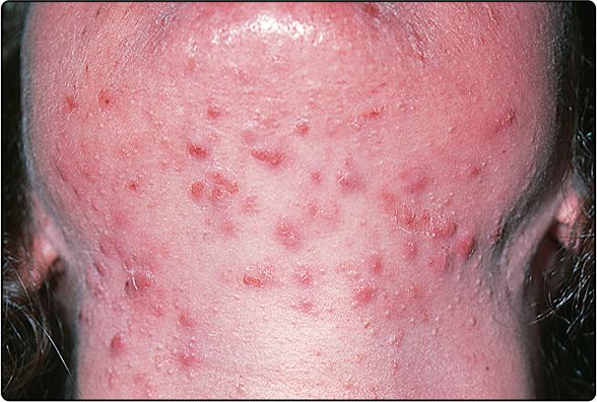 Fig. 36.2, Papular–pustular acne of the chin, with some whiteheads.