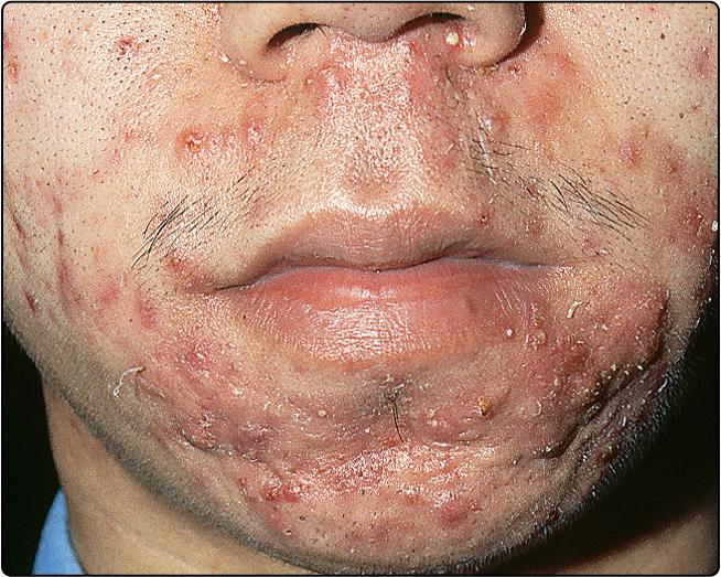 Fig. 36.3, Pustulocystic acne on the face.