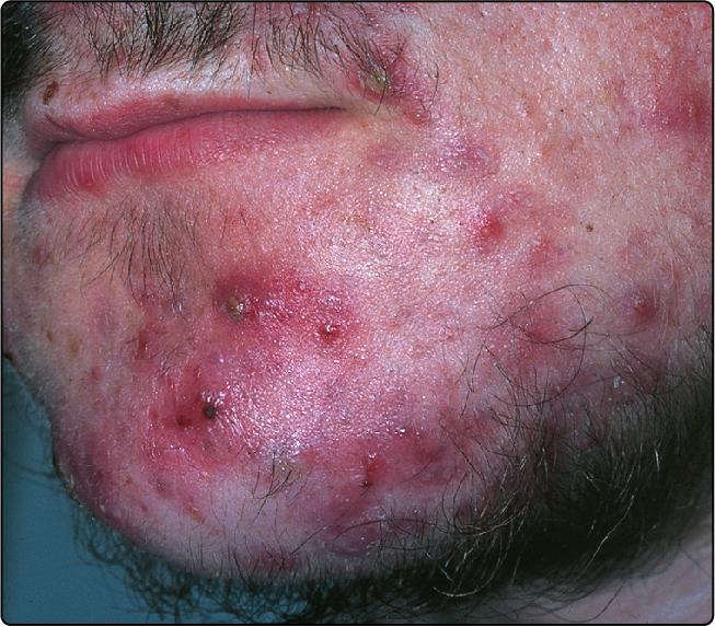 Fig. 36.4, Inflammatory acne with pustules (and some papules and comedones) on the face.