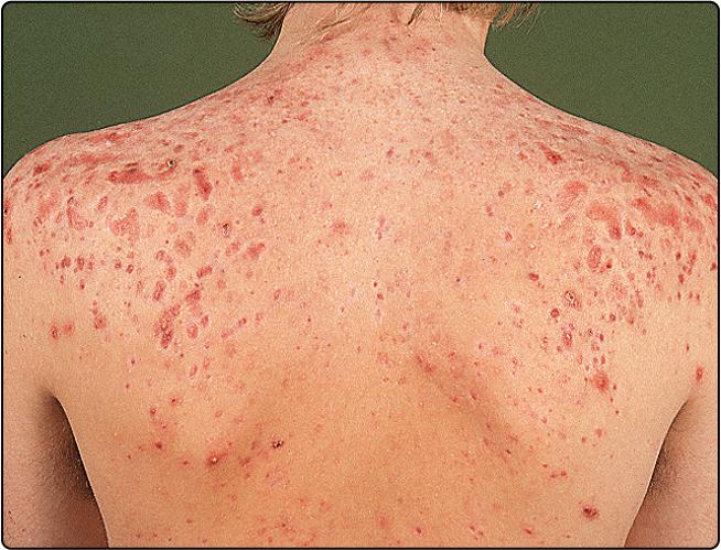 Fig. 36.5, Scarring acne on the back.