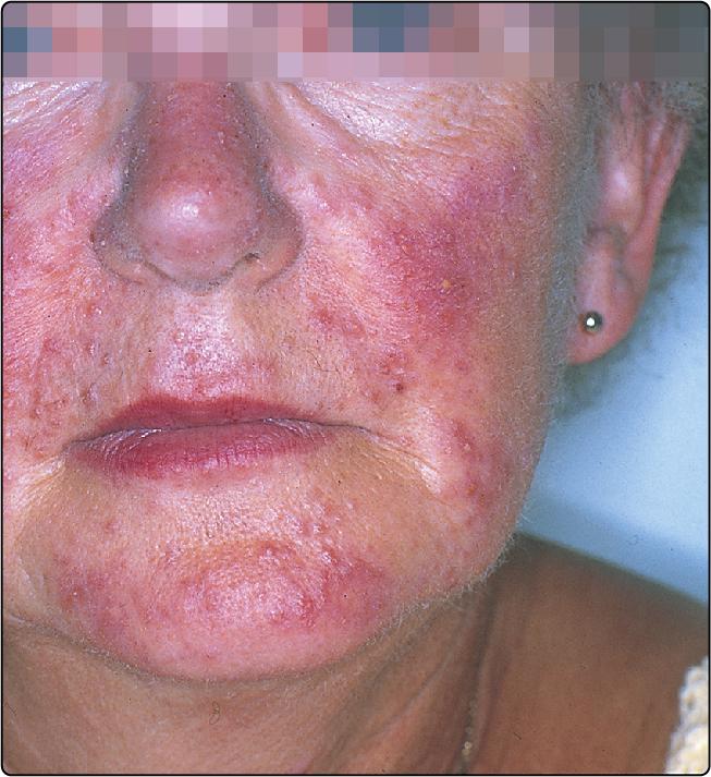 Fig. 37.1, Rosacea showing erythema and papules.