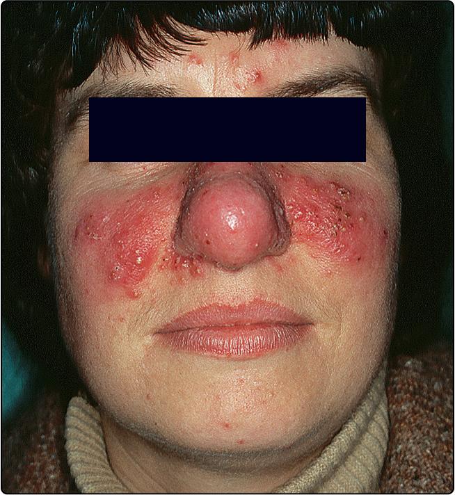 Fig. 37.2, Rosacea with rhinophyma in a woman.