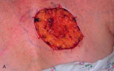 Fig. 3.1, Example of wound progressing through phases of second intention healing. (A) Wound immediately after Mohs surgery for a basal cell cancer. (B) One week after surgery, the wound remains in the inflammatory phase of healing. Note the inflammation along the wound edges and yellow fibrin at the base of the wound. The wound is relatively unchanged in size. (C) One month after surgery, the wound has fully entered the proliferative phase. The base of the wound is filled with glistening pink granulation tissue, the wound has contracted, and newly re-epithelialized skin is advancing along the periphery. (D) Two months after surgery, the wound continues to contract and the new skin continues to advance to the center of the wound. (E) Four months after the surgery, the scar has completely re-epithelialized and it has advanced to the remodeling phase. Note the central ridge along the preferred line of tension, pink color, and prominent telangiectases radiating perpendicularly to the central ridge. (F) Seven years later, the patient returns for more skin cancer treatment. The scar is now hypopigmented. Telangiectases persist.
