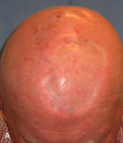 Fig. 3.3, Example of an ideal wound for second intention healing. (A) This patient presented for Mohs surgery of a desmoplastic melanoma that recurred after conventional excision. Note the conspicuous skin graft from his initial surgery. (B) Large Mohs defect. A dermal graft was placed to prevent desiccation of the periosteum, and the wound was left to heal by second intention. (C) One year after the surgery, the wound has healed with a shiny scar that simulates the tight, shiny skin of his bald scalp. Prior to this photograph, he had undergone treatment with the pulsed dye laser to reduce telangiectases.