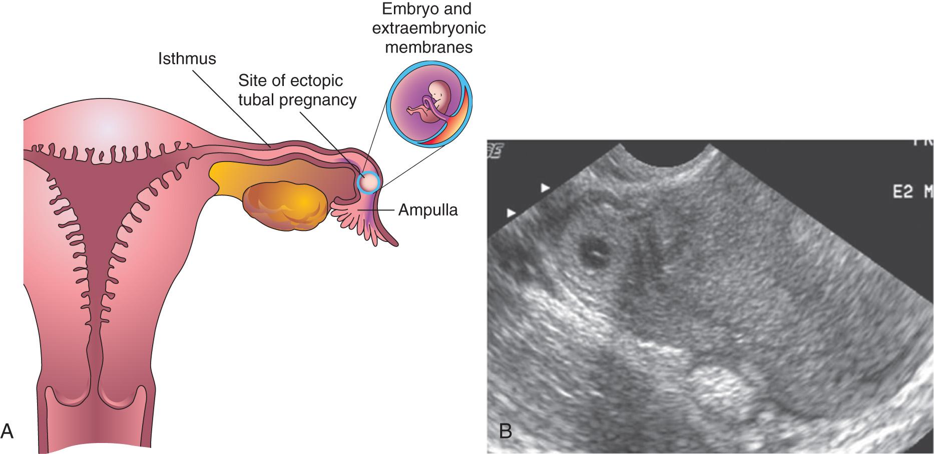 Fig. 3.8, A , Frontal section of the uterus and left uterine tube, illustrating an ectopic pregnancy in the ampulla of the tube. B , Ectopic tubal pregnancy. Endovaginal axial sonogram of the uterine fundus and isthmic portion of the right uterine tube. The dark ring-like mass is a 4-week ectopic chorionic sac in the tube.