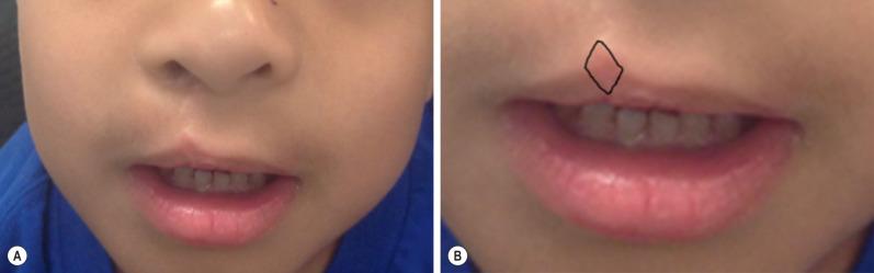 Fig. 3.3.1, (A) A hyperpigmented scar just cephalad to Cupid's peak on the cleft side gives the appearance of an under-rotated repair. (B) This scar can be excised with a diamond shape and closed primarily.