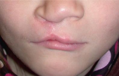Fig. 3.3.2, This shows an under-rotated repair with shortened vertical height of the white lip on the cleft side, as well as a whistling deformity.