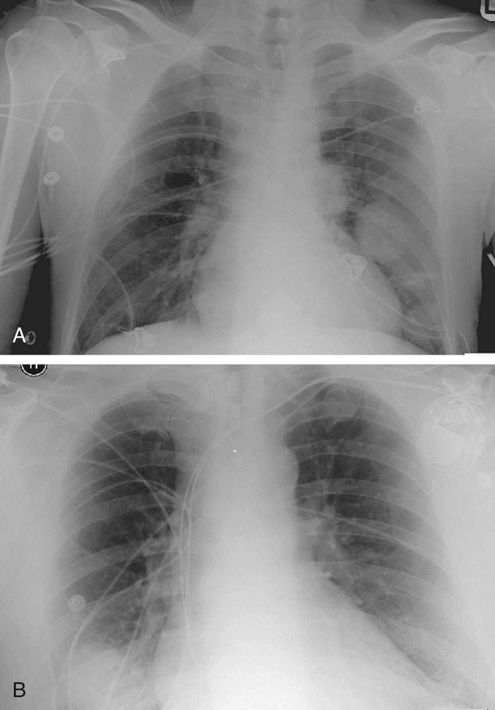 FIGURE 23-1, Pulmonary metastases as detected by chest radiography. A, Left lower lobe metastasis. B, Left upper lobe metastasis.