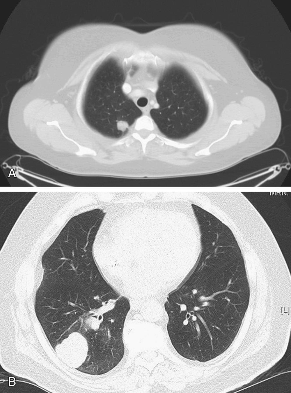 FIGURE 23-2, Pulmonary metastases as detected by chest CT. A, Metastatic lesion in the right upper lobe. B, Metastatic lesion in the superior segment of the right lower lobe.