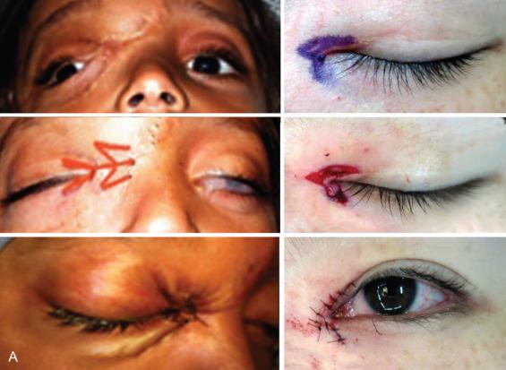 Fig. 3.8.3, (A) Y–V variations of medial epicanthoplasty. (B) Y–V epicanthoplasty 4-month postoperative result.