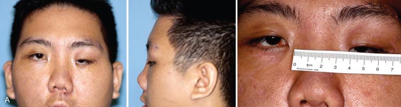 Fig. 3.8.4, (A) Secondary deformity of midface due to inadequate correction of NOE and zygoma. (B) Orbital osteotomy with medialization and superior positioning. (C) Six-month postoperative results demonstrating improvement of the central midface.