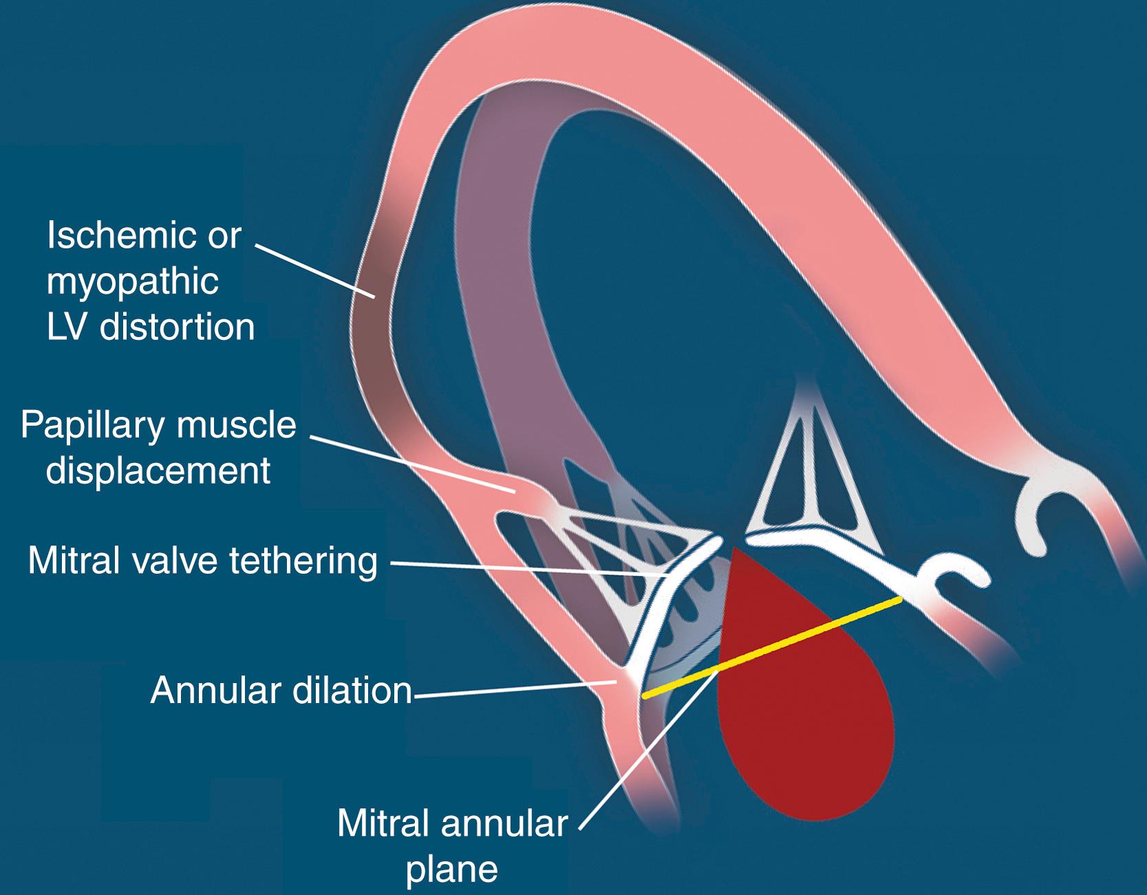 Figure 97.1, Secondary mitral regurgitation caused by ventricular distortion of the mitral valve apparatus. Note the apical and lateral displacement of the papillary muscles caused by left ventricular (LV) remodeling, which results in apical displacement of both mitral valve leaflets relative to the mitral annular plane, that is, “tenting.” (© American Society of Echocardiography.)