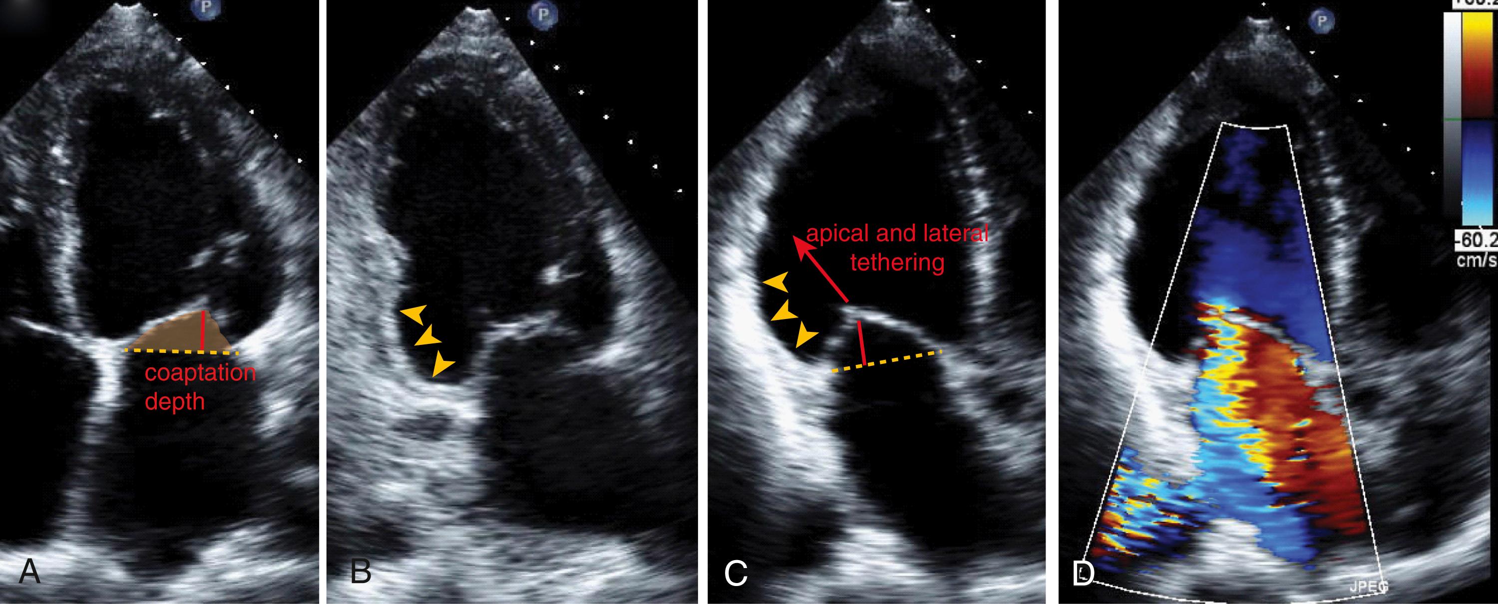 Figure 97.2, Mitral leaflet tethering caused by left ventricular remodeling. A, Transthoracic echocardiogram (apical four-chamber view) illustrating tethering of both the anterior and posterior mitral leaflet due to inferolateral left ventricular wall motion abnormality and remodeling. The coaptation is apically displaced (coaptation depth, red line ) above the annular plane (dashed line) . A tenting area can be measured as well (shaded area) . B, Apical two-chamber view shows inferobasal wall motion abnormality (arrowheads) with severe leaflet tethering. C, Apical long-axis view demonstrates apical and lateral leaflet tethering with increased tenting of the valve (i.e., increased coaptation depth; red line ). D, There is severe secondary mitral regurgitation by color Doppler. (See accompanying Video 97.2A , Video 97.2B , Video 97.2C .)