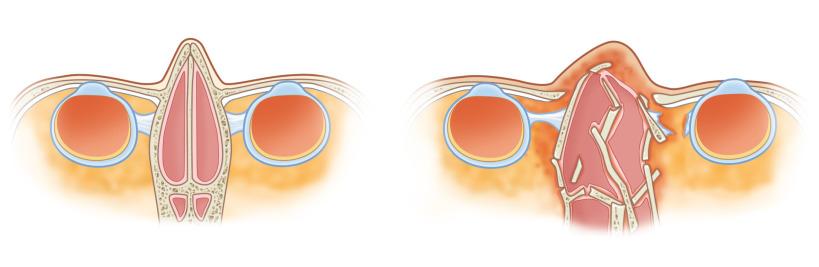 Fig. 3.5.2, Comparison of normal and traumatized nasoethmoid region anatomy. Medial orbital walls with medial canthal tendons displaced laterally. Radix of nose telescopes in. Chronic edema can be present. Collapse of the septum and vomer is frequently seen.
