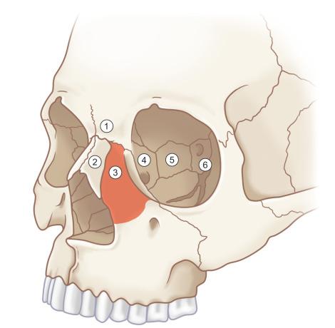 Fig. 3.5.3, Nasoethmoid region osseous components: (1) nasal process of frontal bone; (2) nasal bones; (3) nasal process of maxilla; (4) lacrimal bone; (5) lamina papyracea; (6) lesser wing of sphenoid bone. The key central bone fragment is shaded.