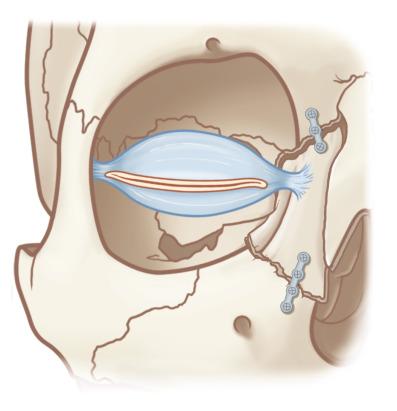 Fig. 3.5.6, Displaced nasoethmoid fracture plated in nonanatomical position. Persistent abnormalities can be caused by inadequate reduction of the primary defect, as shown in this medial bone fragment malpositioning.