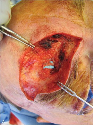 Fig. 3.16.2, (A) Intraoperative image of the supraorbital nerve within the foramina and its associated neuroma. (B) Identification of lateral branch leading to a neuroma. (C) Lateral branch terminating in a neuroma. Seen directly under the laterally placed retractor. (D) Neuroma clearly seen at the end of the proximal nerve stump.