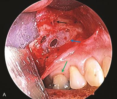 Fig. 3.16.3, (A) Intraoperative photograph of the terminal branch of the maxillary division (V 2 ). Black arrow points to the compression of the nerve as it leaves the foramen within the anterior wall of the maxilla. A portion of the anterior wall of the maxilla is removed and the maxillary sinus membrane ( blue arrow ) is visible. The location of the nerve is usually above the roots of the maxillary first molar ( green arrow ). (B) Surgical decompression of the nerve by removing the compressive bone surrounding the nerve.