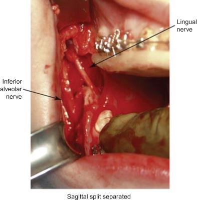 Fig. 3.16.4, Intraoperative photo of the mandibular nerve in a bilateral sagittal split osteotomy.