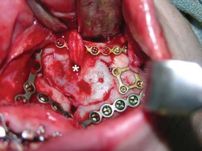 Fig. 3.3.1, Exposure and fixation of the infraorbital rim through an upper buccal sulcus approach. The nerve and infraorbital foramen are marked by the asterisk (*).