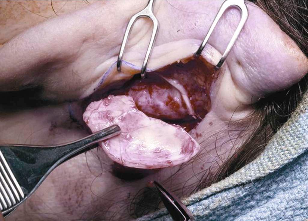 Figure 7-1, Intraoperative view of auricular cartilage graft harvested via a postauricular incision.