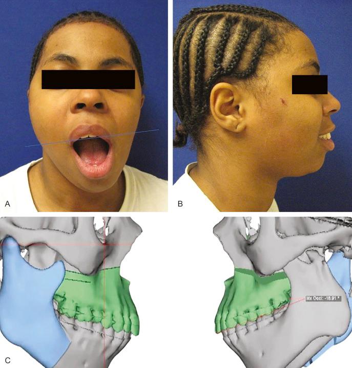 Fig. 3.10.2, Posttraumatic unilateral condylar hypoplasia, malunion with displacement in a young patient. Note chin deviation on opening to the affected side. The 3D reconstructed image (C) demonstrates the extent of left condylar hypoplasia.