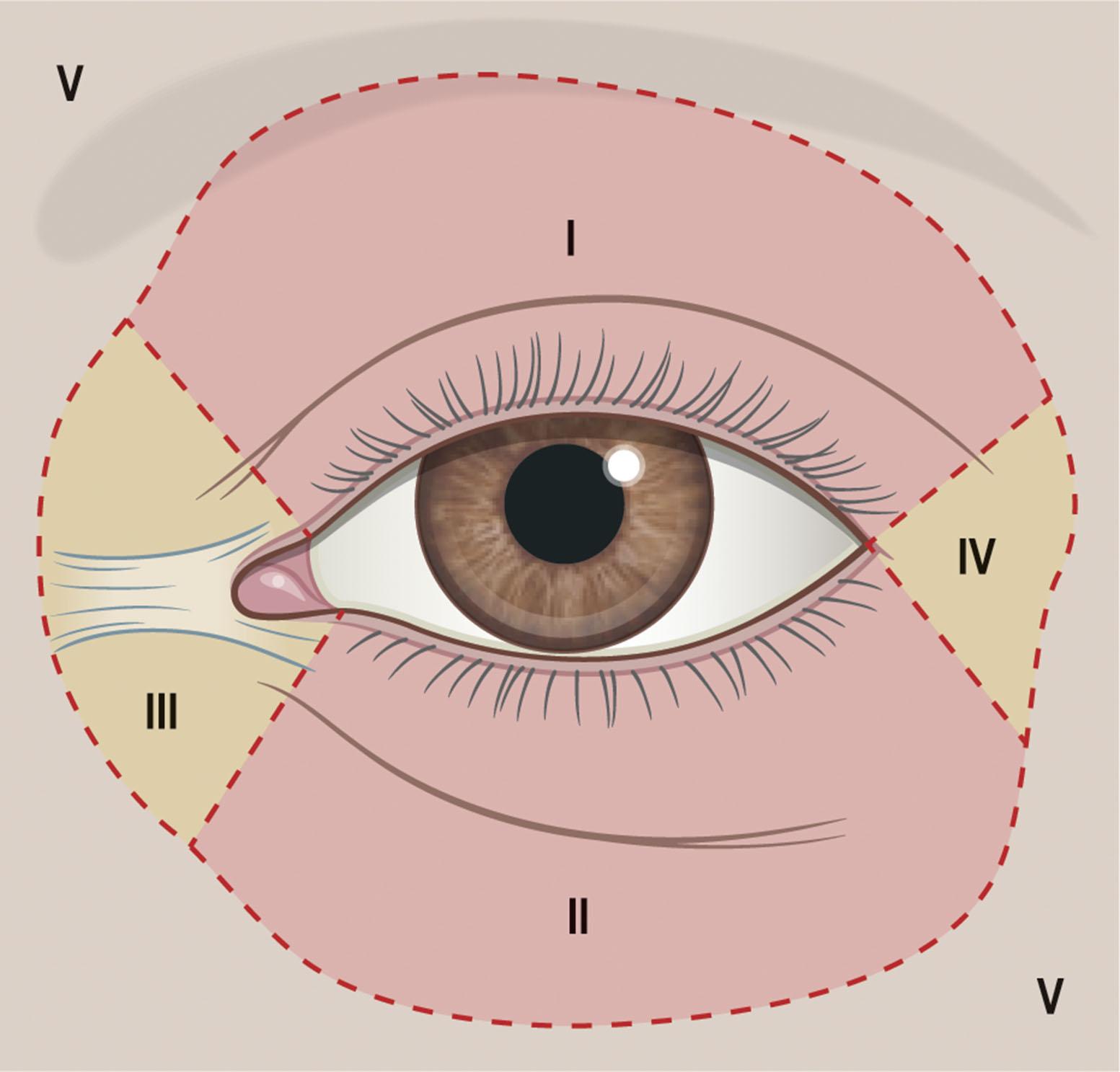 Figure 14.1, Anatomical zones of the eyelids and periocular structures. Zone I, upper eyelid; zone II, lower eyelid; zone III, medial canthal structures including the lacrimal drainage system; zone IV, lateral canthal area; zone V, periocular contiguous area – glabella, eyebrow, forehead, temple, malar, nasojugal and nasal areas. Tissue in the periocular region outside of the eyelids (zones III–V) is thicker and less pliable. Examination of position and pliability of this tissue must be performed to understand its contribution to eyelid deformities.