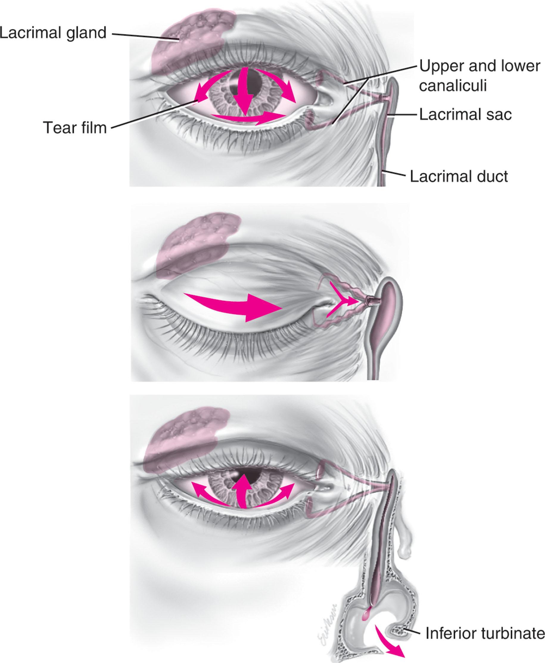 Figure 14.3, Activation of the preseptal, pretarsal, and orbital portions of the orbicularis oculi muscle close the eyelid. Contraction of the lacrimal portion of the orbicularis moves the lacrimal canals into position to drain the tear film.