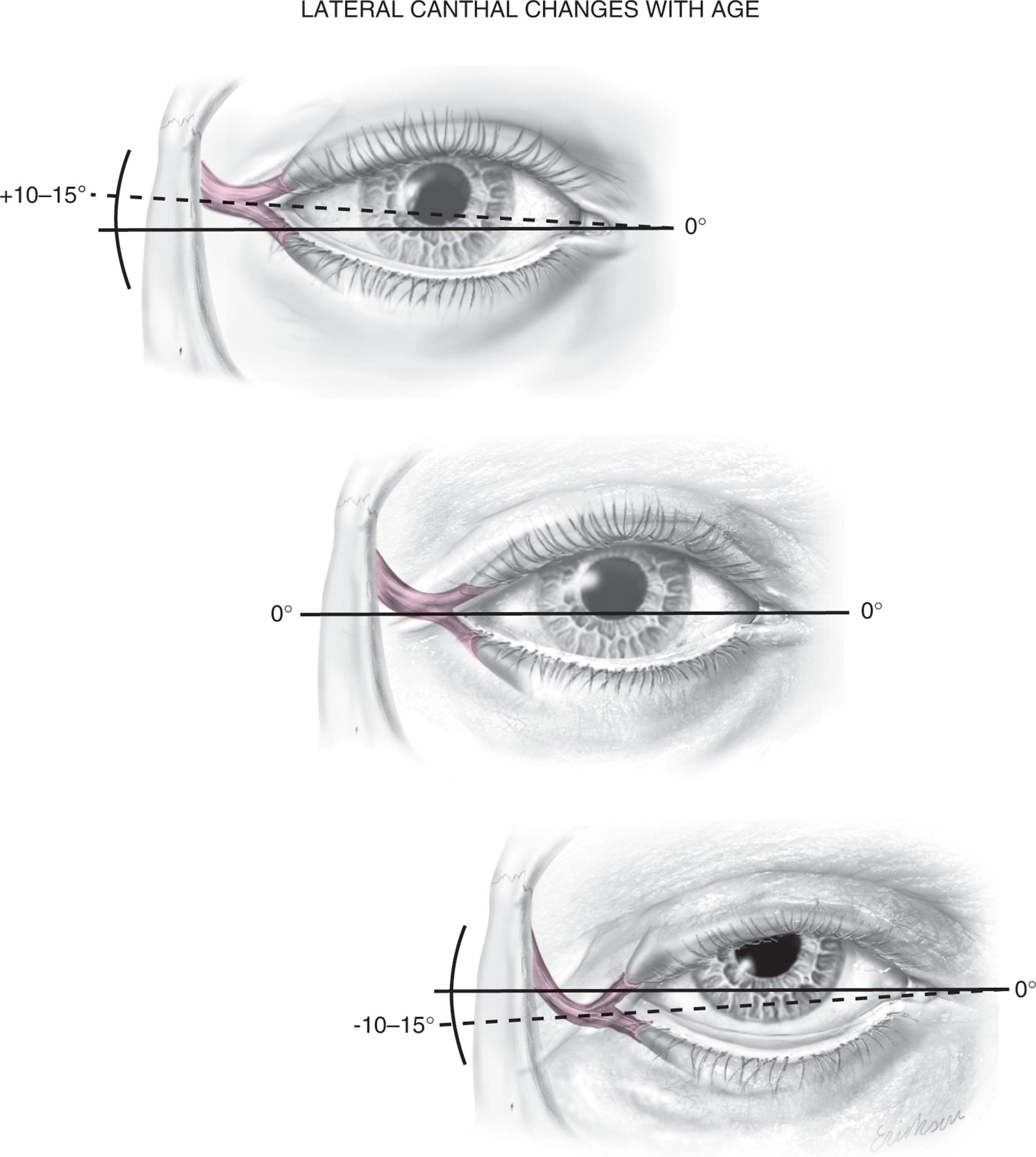 Figure 14.5, Attenuation and gravitational forces can lead to lateral canthal declination and, as this figure demonstrates, expected sequalae include septal laxity and eyelid malposition. (A–C) The lateral canthus is normally inclined cephalad by 10–15° compared with the medial canthus. Attenuation with aging produces a descent of the lateral canthus which rotates (clockwise on the left and counterclockwise on the right) around the medial canthus. The end result is a lateral canthus that is coplanar or declined compared with the medial canthus. As the lateral canthus sags inferiorly, the intercommisure distance shortens (distance between medial and lateral canthus) and the lower lid and inferior lateral septum become lax. This produces scleral show, ectropion or entropion, orbital fat prominence especially laterally, and tear film distribution and drainage problems.