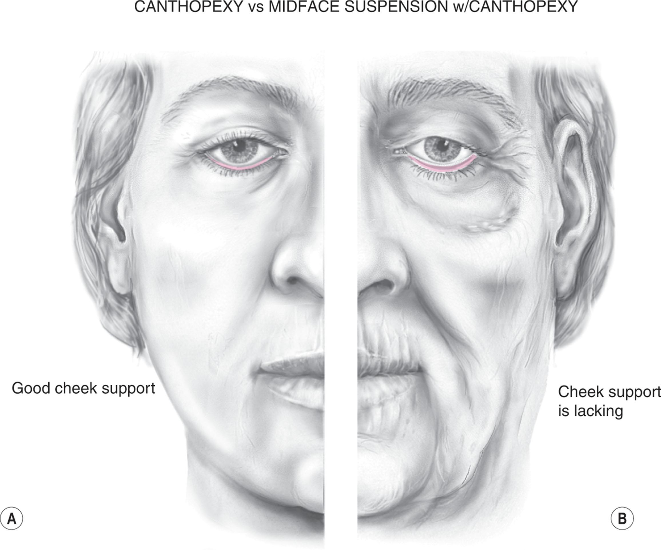 Figure 14.6, A critical examination distinction is the degree of cheek support a patient has. The patient depicted in (A) has lower lid laxity and scleral show with only modest descent of malar soft tissues, which is confirmed by noting the relatively short distance between the lower lid margin and the cheek. This patient’s lower lid ptosis could be treated with a canthopexy alone. In contrast, the patient depicted in (B) has significant scleral show with a large difference between the lower eyelid and cheek soft tissues even with the lower eyelid having descended. Using a canthal procedure alone will not be sufficient and should not be attempted to support the malar soft tissue alone. Instead, this patient would require midface suspension as well as a canthal procedure.