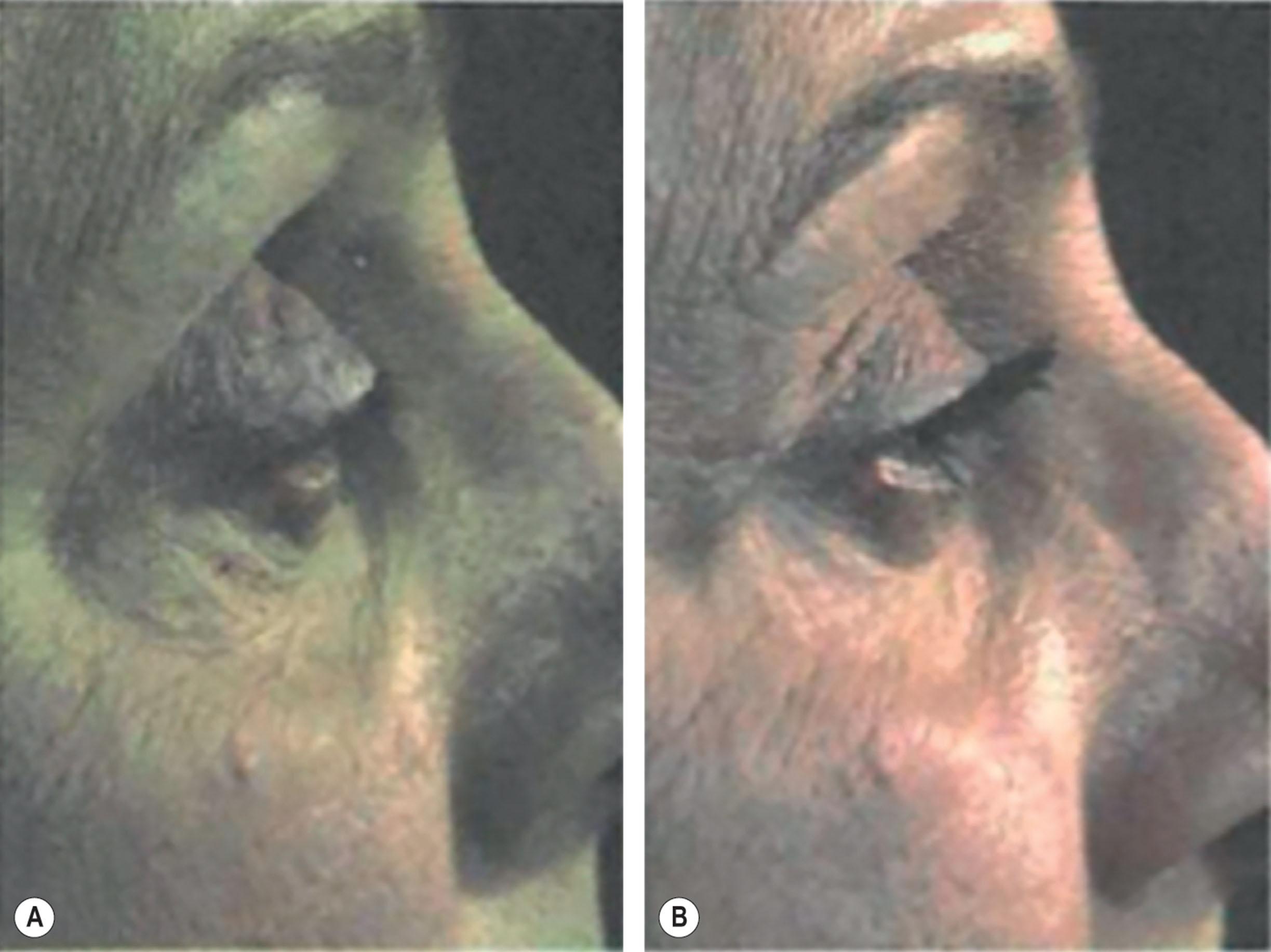 Figure 14.7, (A) Patient with lateral canthal effacement with displacement laterally and inferiorly. (B) Patient after correction with lateral canthal tendon resuspended helping to correct lower eyelid ptosis.