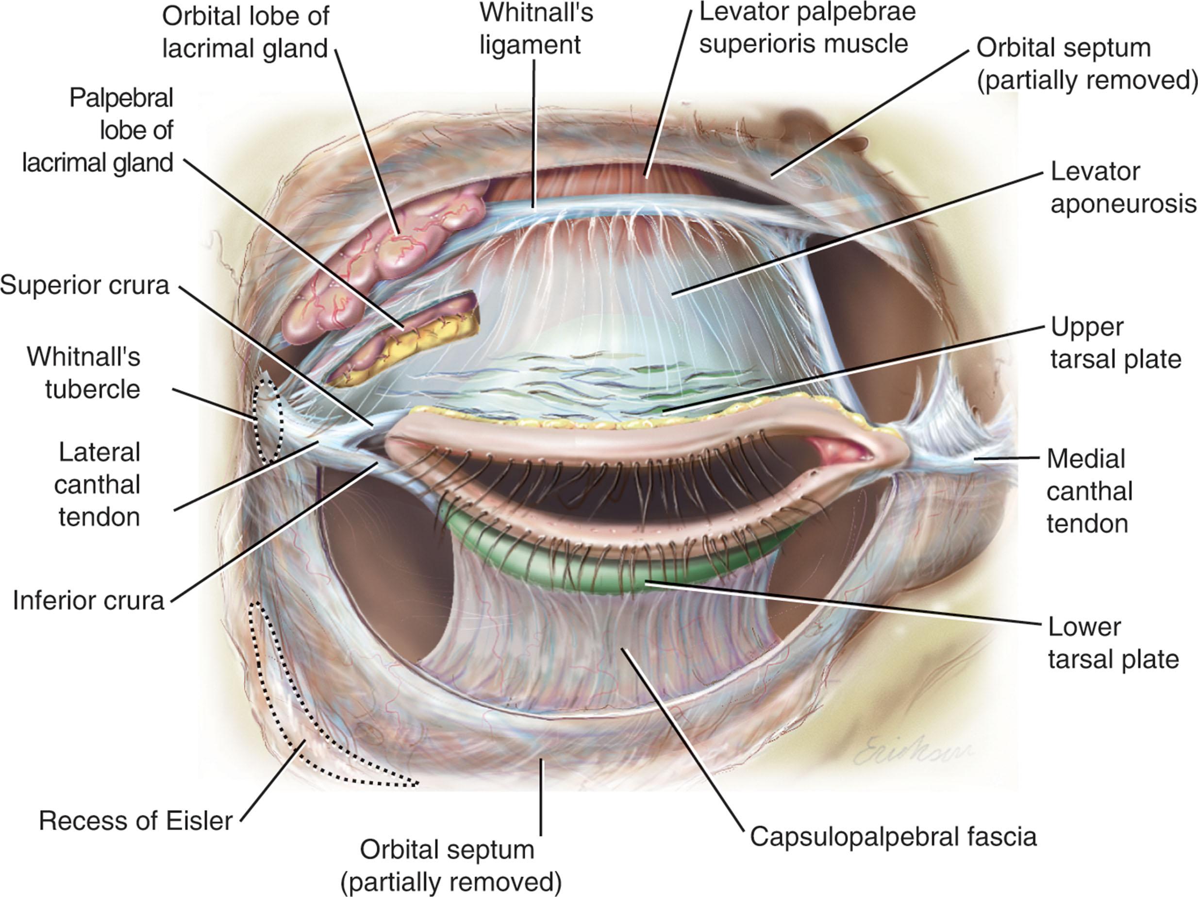 Figure 14.8, The upper and lower eyelids are suspended in space and can be thought of as completing a sling between the medial and lateral canthal tendons. Even millimeters of displacement of the position of the point where the lateral canthal tendon joins with the tarsal plates and orbicularis muscle can disrupt the position and function of the upper and lower eyelids. Note the three-dimensional construct of the eyelids’ supportive structures and orbital bony confines. The eyelids are effectively hanging in space, suspended medially and laterally.