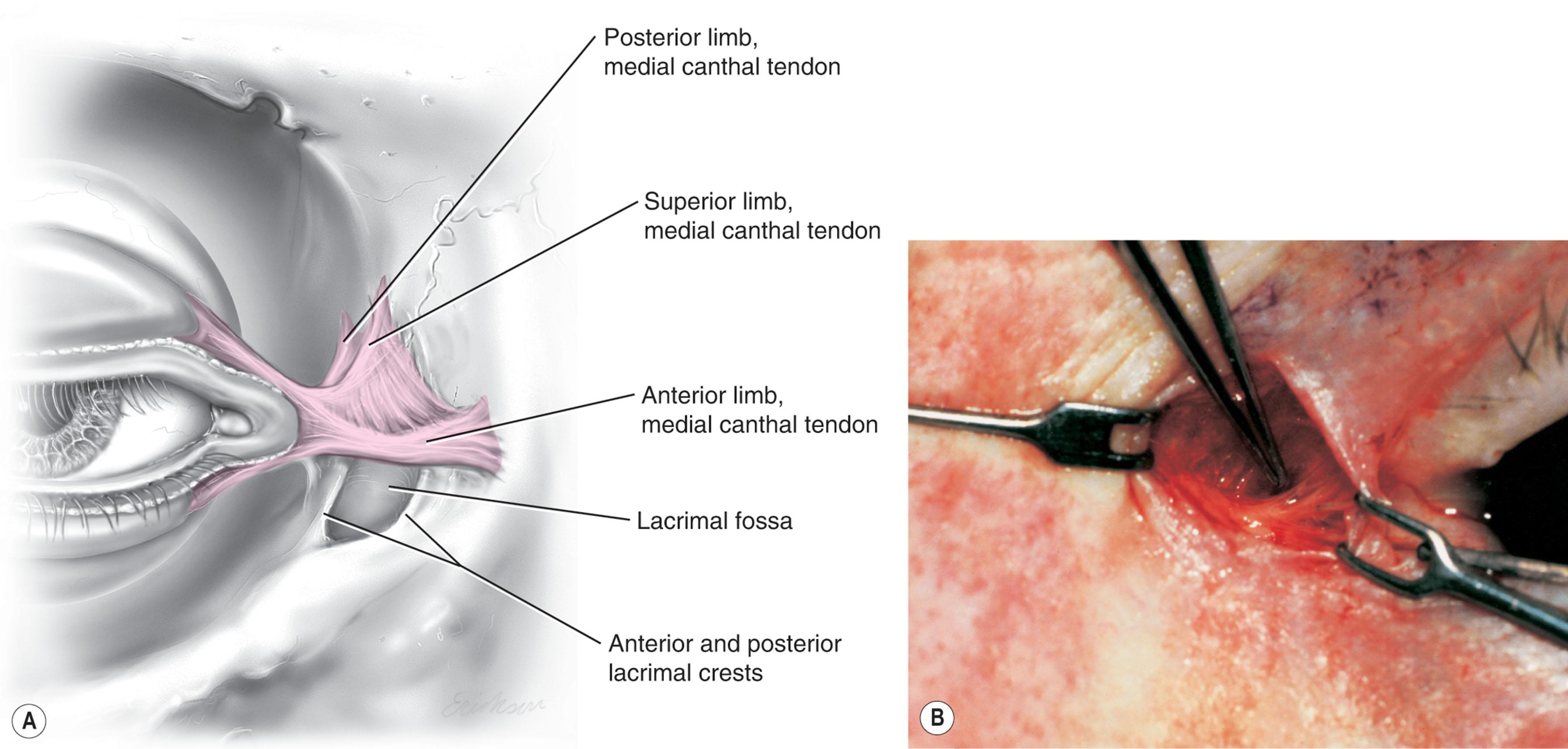 Figure 14.9, In (A) note the medial canthal tendon is the culmination of the medial canthal retinaculum, the confluence of the deep head of the pretarsal orbicularis, the orbital septum, the medial end of Lockwood’s ligament, the medial horn of the levator aponeurosis, the check ligaments of the medial rectus muscle, and Whitnall’s ligament. As seen in (B) , care must be taken when repositioning the medial canthal tendon to preserve this confluence and reposition the entire structure as a whole. The medial canthus’ three bony attachments, upper and lower canaliculi, and lacrimal fossa are all in close proximity.