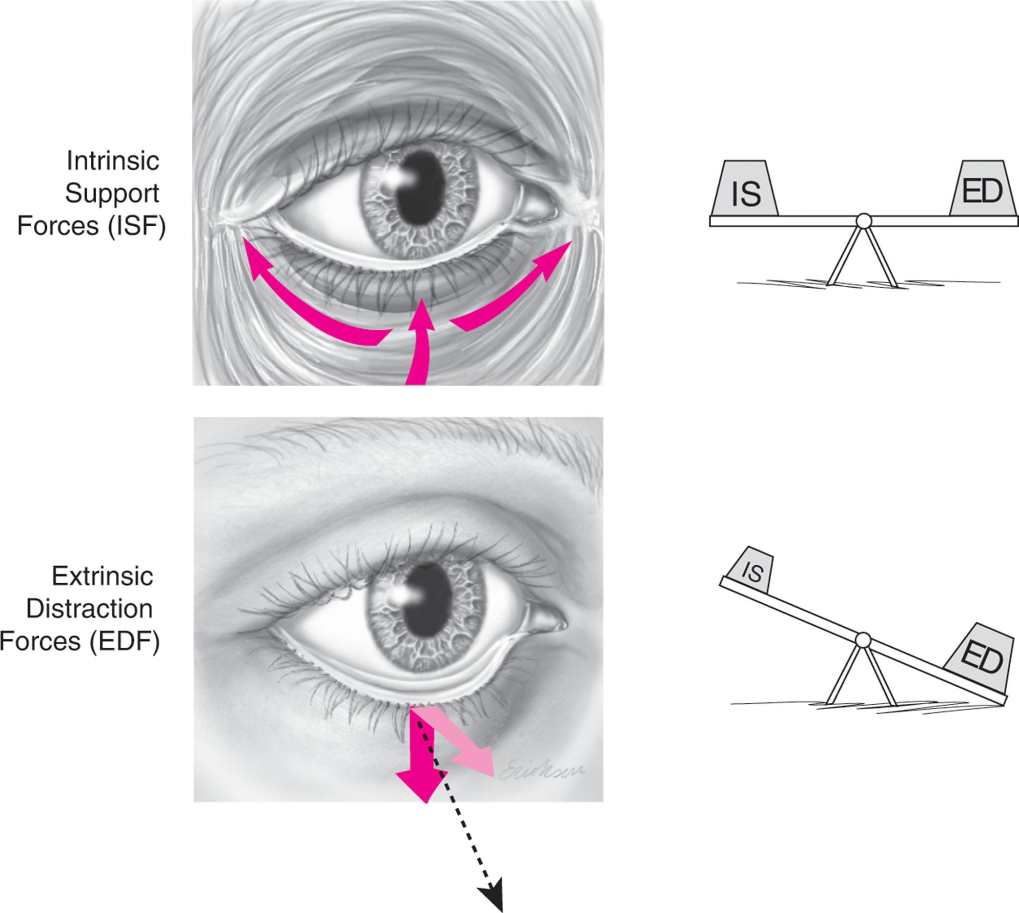 Figure 14.10, The lower eyelid is held against the globe by intrinsic support provided by the tarsal plate, canthal tendons, and orbicularis muscle sling. In normal function the net vector of these forces is posterior and superior. Any forces that increase extrinsic distraction forces such as senescence, surgery, lasers, or trauma can disrupt the normal apposition of the lower eyelid to the globe. The lower lid position is determined by a balance of two opposing forces which may be affected by senescence and/or procedures.