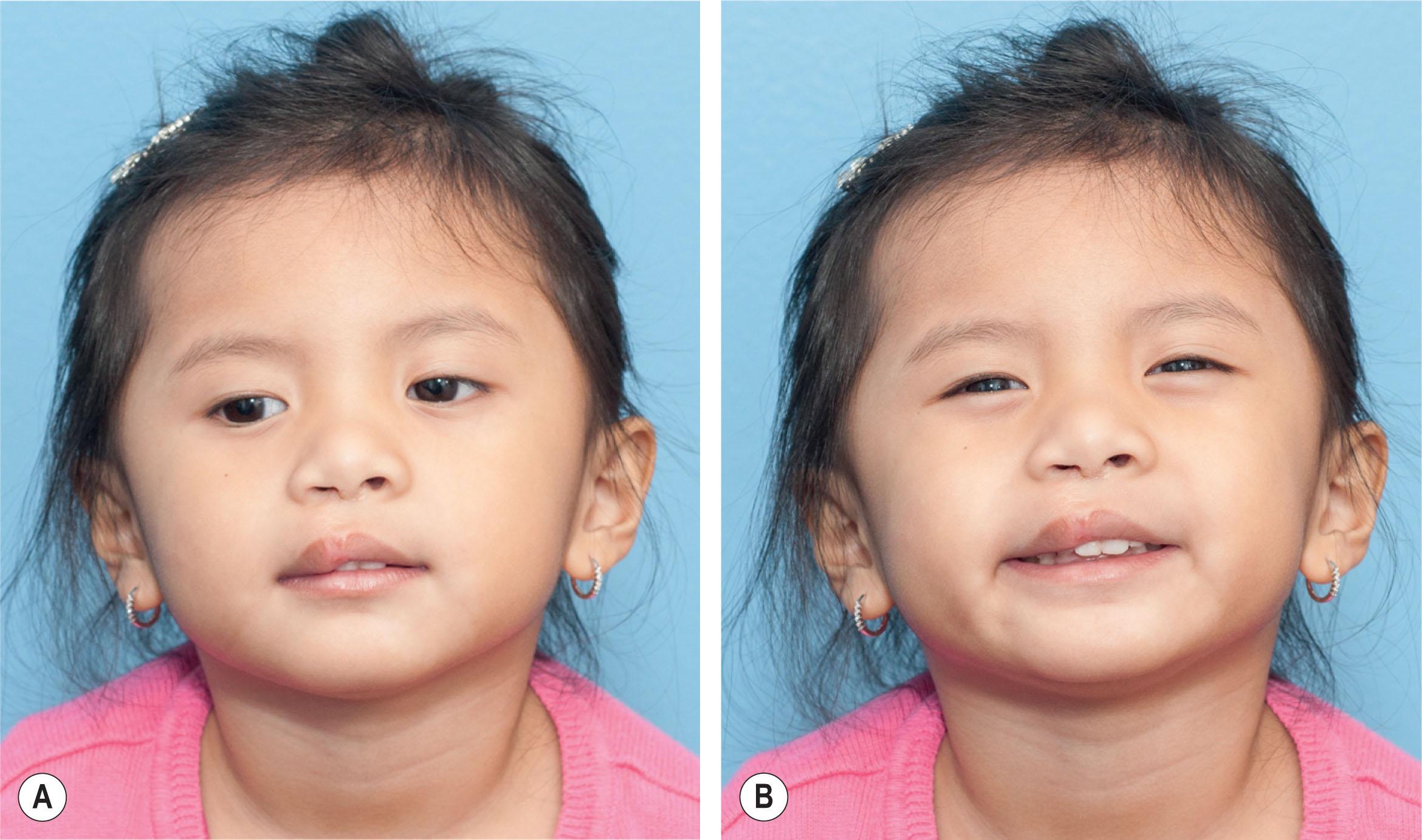 Figure 21.10.1, A young female with lateral vermilion fullness. This affects the patient in repose (A) with contour changes along the free vermilion border, as well as when smiling (B) .